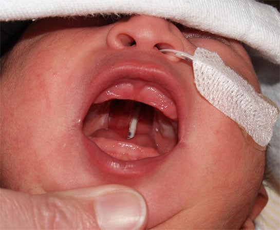 cleftpalate2 by Janelle Aby, MD Stanford University Medical Center.jpg